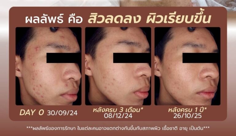 Three-panel acne treatment progress on a woman's face: Day 0, 3 months later, and 1 year later, with Thai captions.