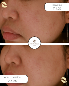 miin laser ลดรอย จุดด่าง ดำ รอยสิว PIH หน้าขาวใส รูขุมขนกระชับ หลุมสิว