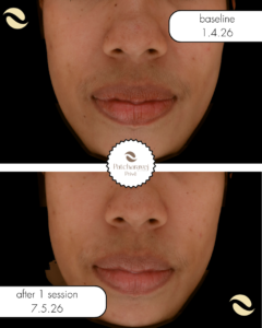 miin laser ลดรอย จุดด่าง ดำ รอยสิว PIH หน้าขาวใส รูขุมขนกระชับ หลุมสิว