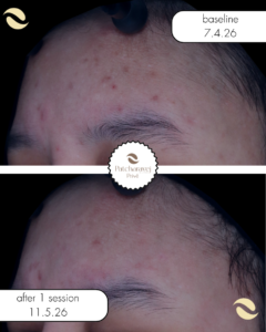 miin laser ลดรอย จุดด่าง ดำ รอยสิว PIH หน้าขาวใส รูขุมขนกระชับ หลุมสิว
