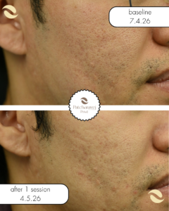 miin laser ลดรอย จุดด่าง ดำ รอยสิว PIH หน้าขาวใส รูขุมขนกระชับ หลุมสิว