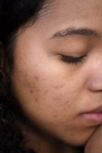 Extreme close-up of a woman's face showing skin imperfections and calm expression.